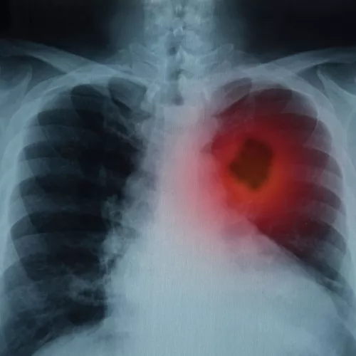 lung xray