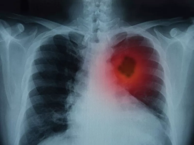 lung xray