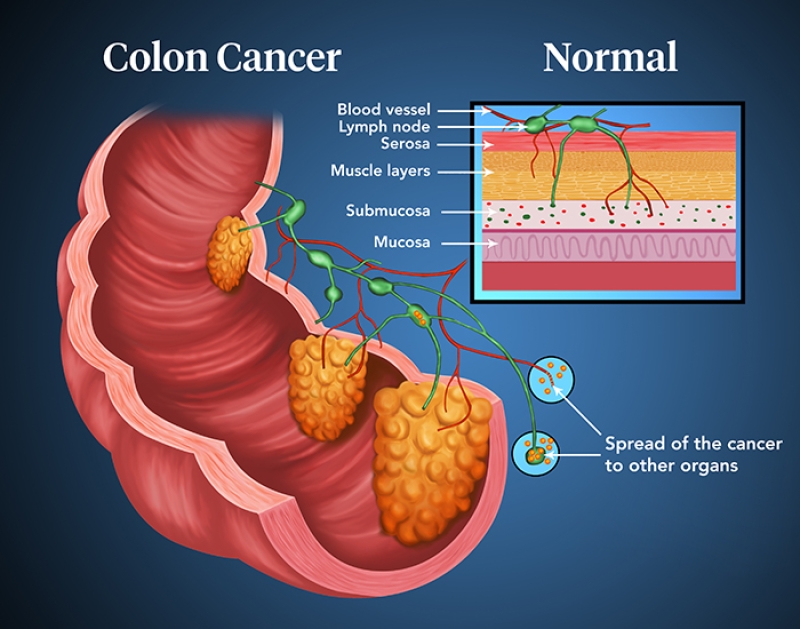 diagram of colon cancer forming